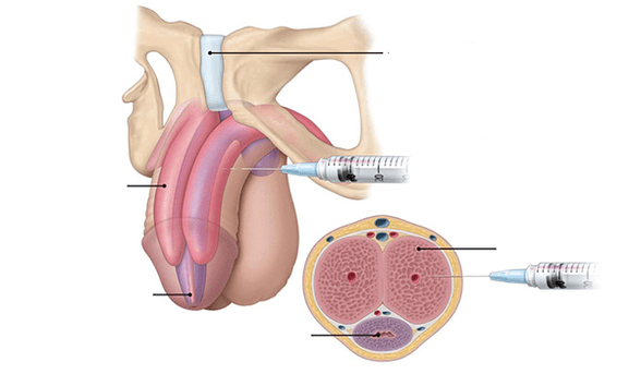 inject your own fatty tissue to thicken the penis