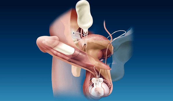 silicone and gel thickening fillers